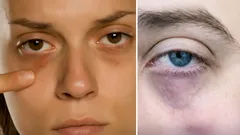 Mörka ringar under ögonen? Experterna listar de vanligaste orsakerna – och hur du blir av med dem